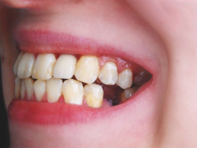 Thời gian trồng lại răng cấm sau khi nhổ thường từ 1–3 tháng để vết thương lành và xương hàm ổn định
