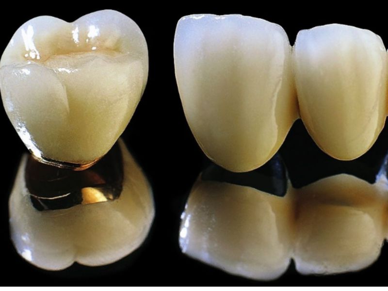 Răng sứ Titan có khung sườn bên trong làm từ hợp kim Titan và lớp sứ trắng bên ngoài