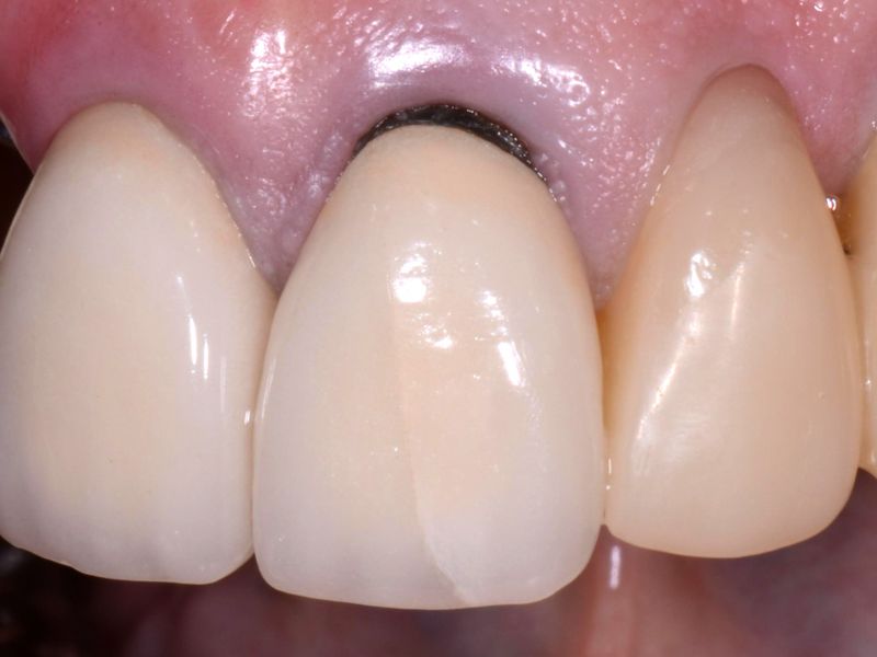 Nhược điềm răng sứ Titan gây đen viền nướu