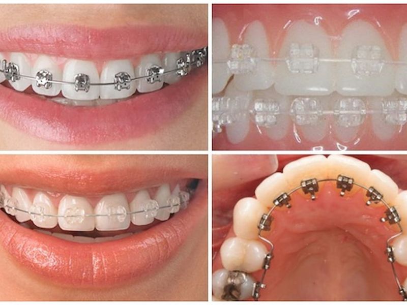 Chi phí niềng răng 2 hàm thường dao động trong khoảng 25 triệu đến 130 triệu đồng