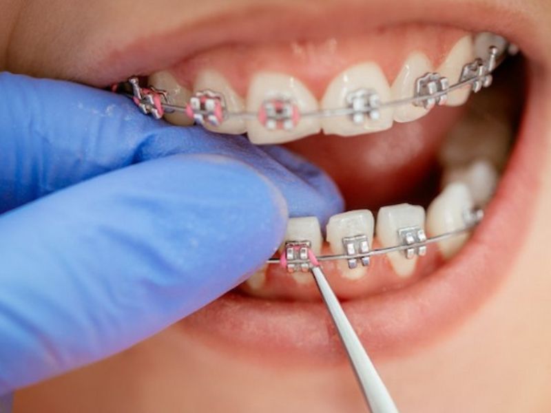 Địa chỉ nha khoa, tay nghề bác sĩ là các yếu tố ảnh hưởng tới chi phí niềng răng