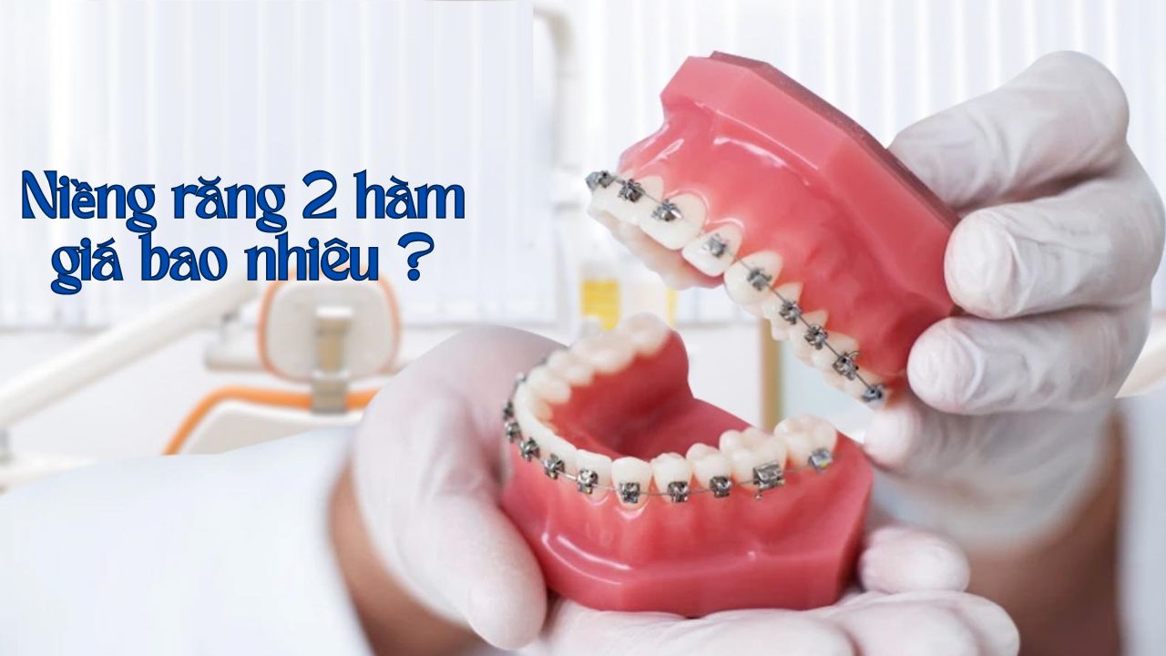 Niềng răng 2 hàm bao nhiêu tiền? Có trả góp được không?