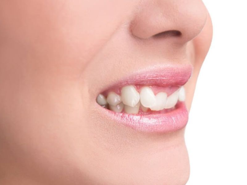 Khớp cắn sâu là tình trạng răng hàm trên che phủ quá mức răng hàm dưới khi cắn chặt lại, thường từ 4mm đến 10mm
