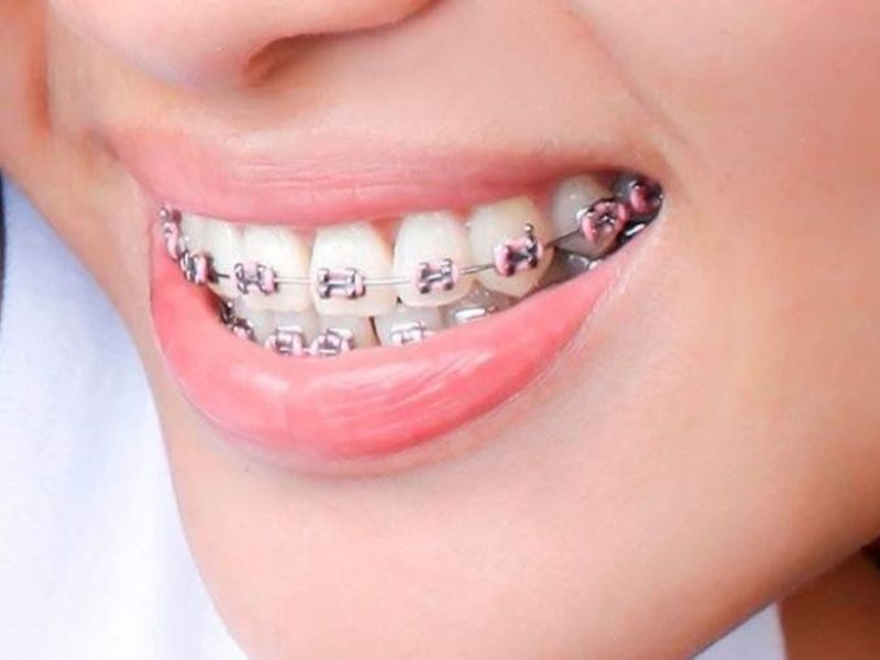 Quy trình niềng răng khớp cắn sâu