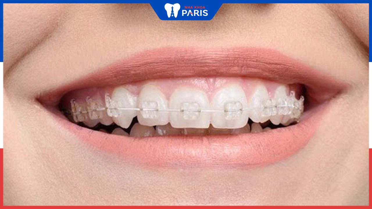 Khớp cắn sâu là gì? Niềng răng khớp cắn sâu mất bao lâu