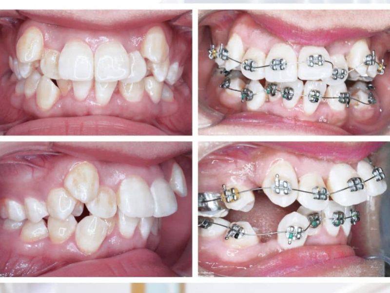 Niềng răng – Giải pháp điều chỉnh răng lệch lạc hiệu quả
