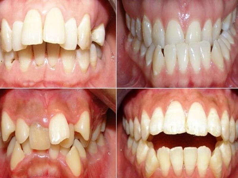 Răng lệch lạc ảnh hưởng đến thẩm mỹ còn gây ra nhiều vấn đề về sức khỏe răng miệng