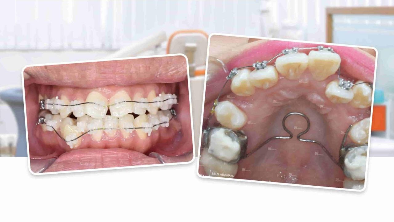 Niềng răng lệch lạc: 4 phương pháp chỉnh nha hiệu quả