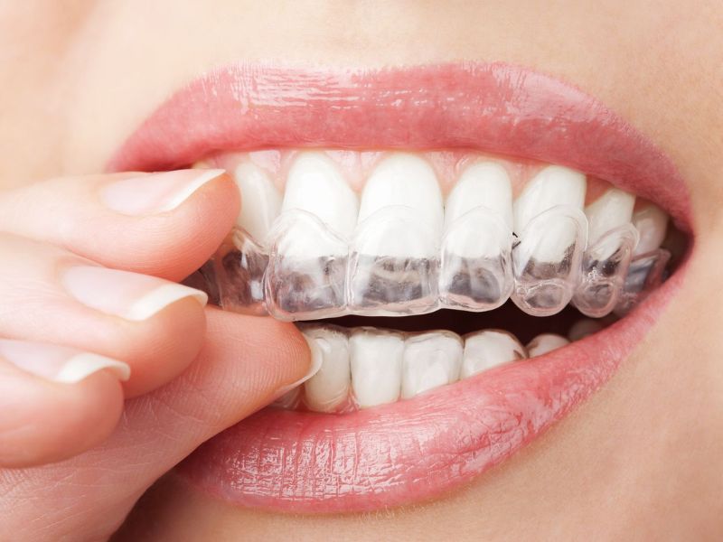 Niềng răng máng trong suốt sử dụng các khay nhựa trong suốt (aligner) để dịch chuyển răng từ từ về vị trí mong muốn