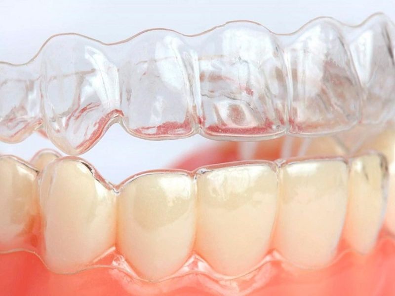 Quy trình niềng răng máng trong suốt