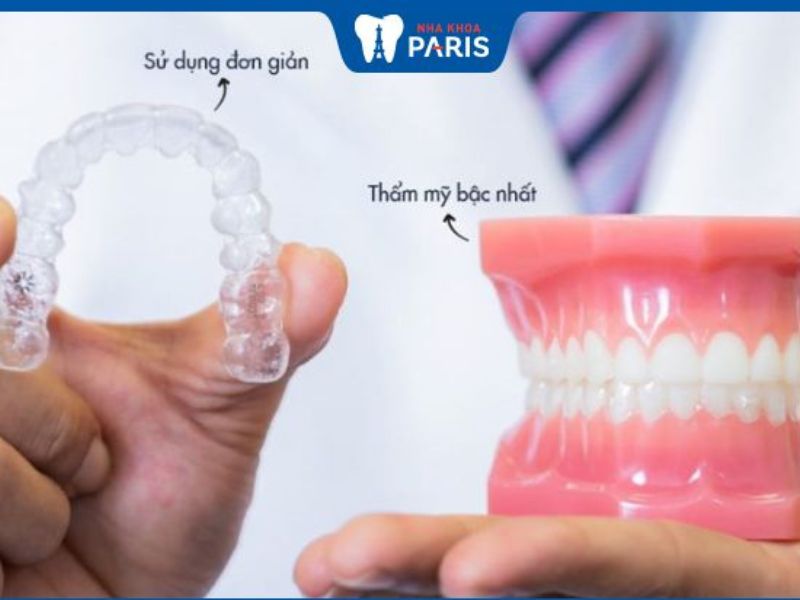 Ưu điểm niềng răng máng trong suốt