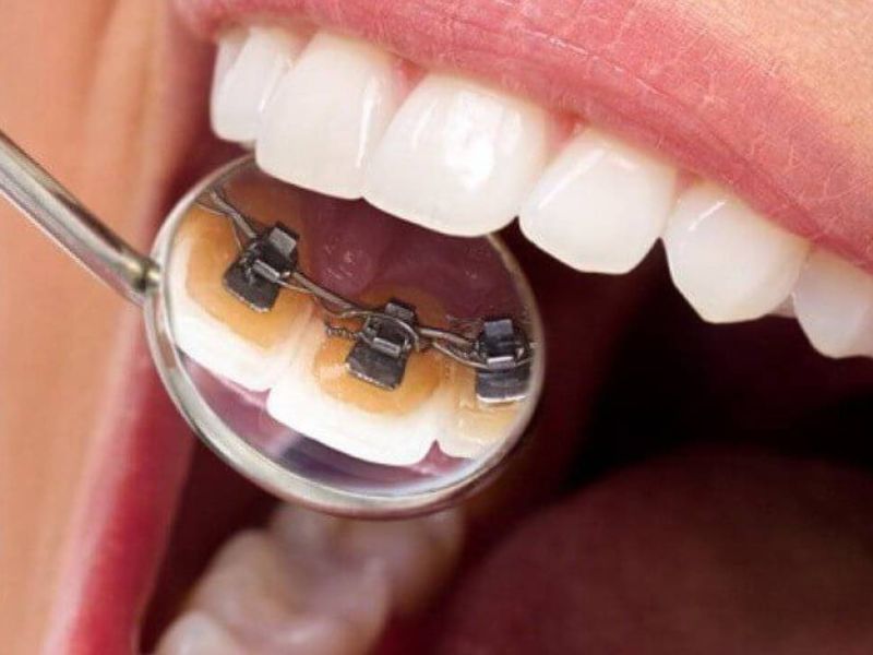 Chi phí niềng răng mặt lưỡi dao động từ khoảng 70 triệu đến hơn 150 triệu đồng