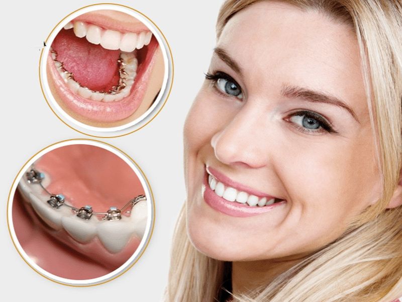 Ưu điểm của niềng răng mặt lưỡi