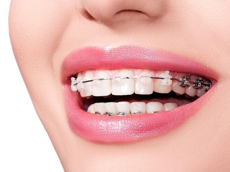 Địa chỉ niềng răng uy tín tại TP.HCM quyết định đến hiệu quả và độ an toàn của quá trình chỉnh nha.