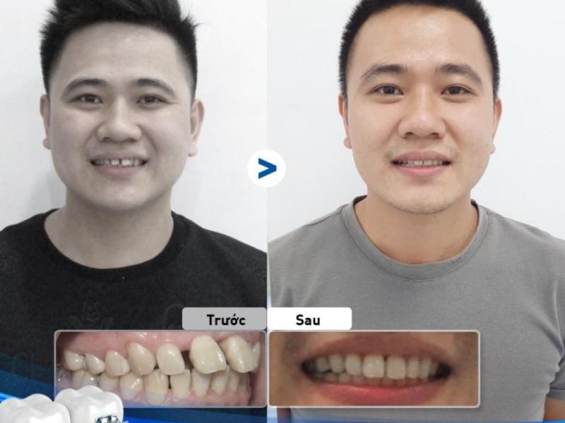Hình ảnh kết quả trước – sau niềng từ khách hàng tại địa chỉ nha khoa uy tín