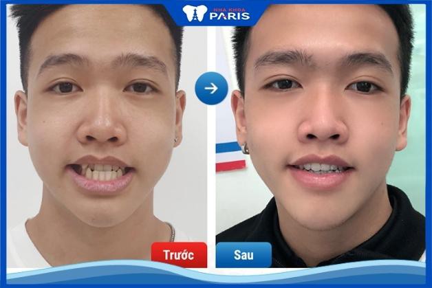 Phản hồi của khách hàng sau khi niềng răng tại nha khoa Paris