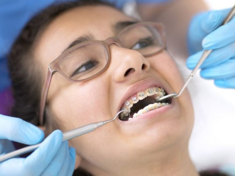 Up Dental - Địa chỉ niềng răng tốt tại TPHCM