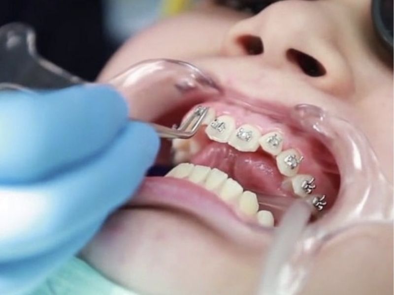 Platinum Dental - Cơ sở nha khoa niềng răng uy tín tại tphcm