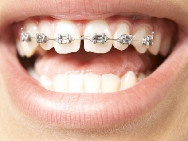 Thời gian niềng răng thưa sẽ dao động từ 6 tháng - 2 năm