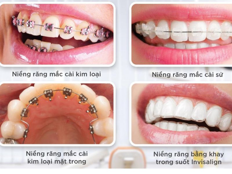 Các phương pháp niềng răng thưa phổ biến