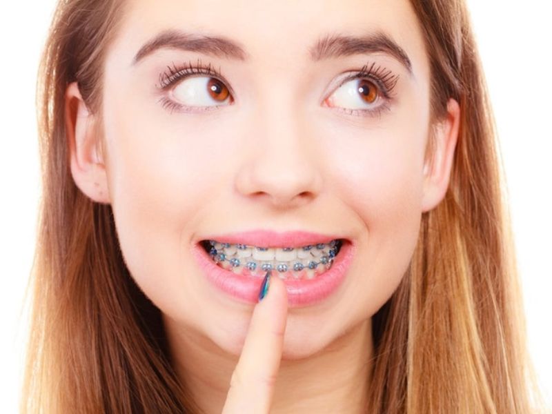 Sinh viên trong độ tuổi từ 18 đến 22 hoàn toàn có thể niềng răng vì đây được xem là “thời điểm vàng” để chỉnh nha