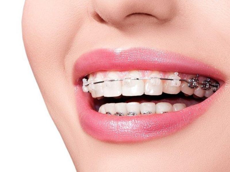 Ưu- nhược điểm khi niềng răng trả góp Hà Nội