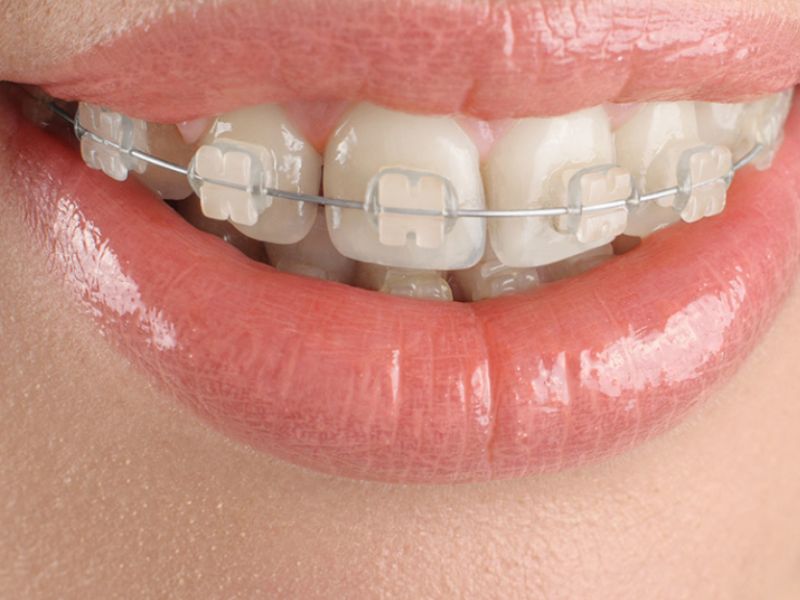 Điều kiện niềng răng trả góp tại HCM