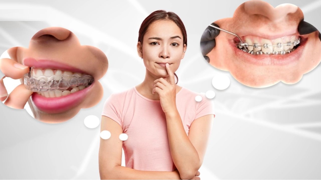 Niềng răng trả góp HCM uy tín, giá tốt với lãi suất 0%
