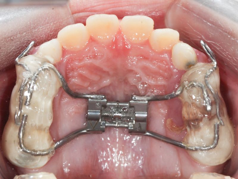 Nong hàm là kỹ thuật mở rộng cung hàm bằng khí cụ chuyên dụng, tạo thêm không gian cho răng mọc đều mà không phải nhổ răng