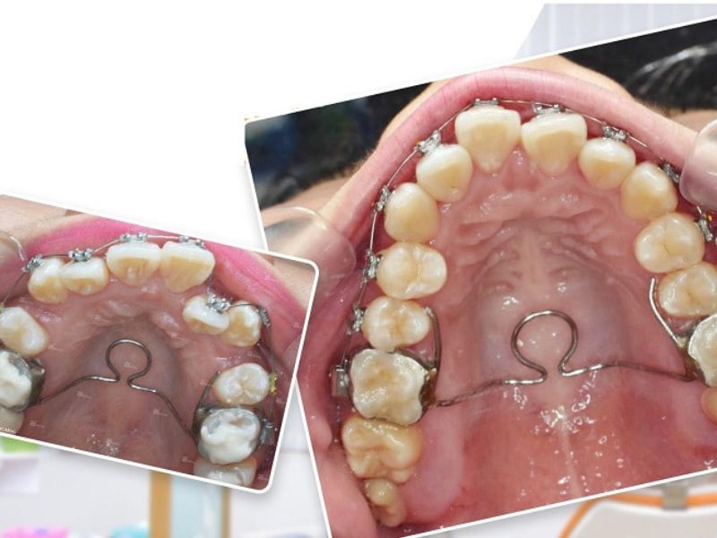 Quy trình nong hàm niềng răng 