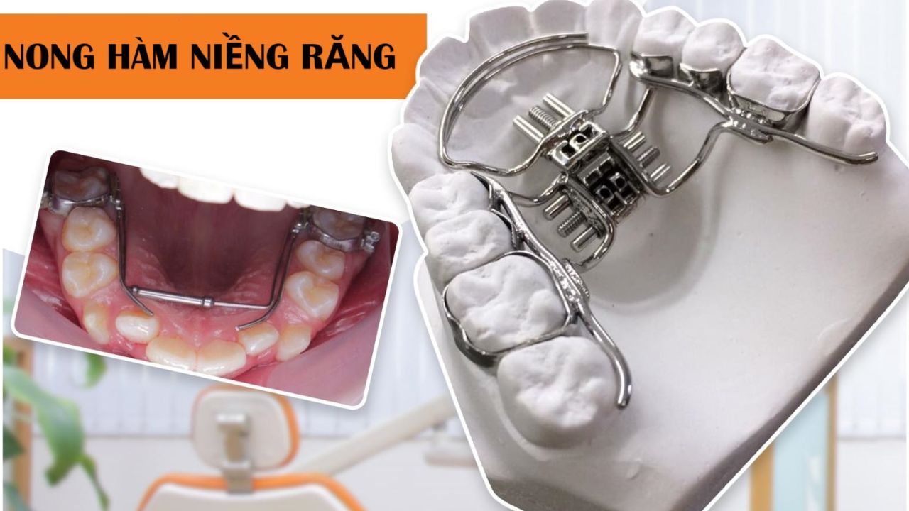 Nong hàm niềng răng: Khi nào cần thực hiện và quy trình các bước