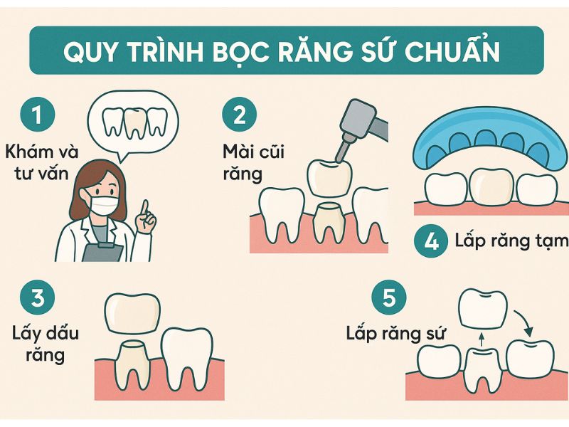 Quy trình bọc răng sứ chuẩn 5 bước