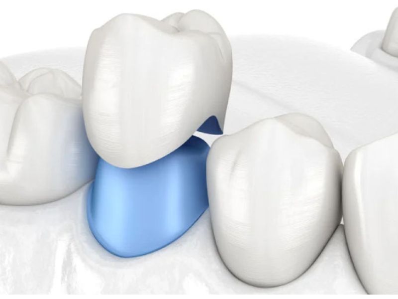 Bọc răng sứ có thể hoàn thành trong 1 ngày nếu không cần điều trị tủy và nha khoa có hệ thống chế tác sứ CAD/CAM tại chỗ