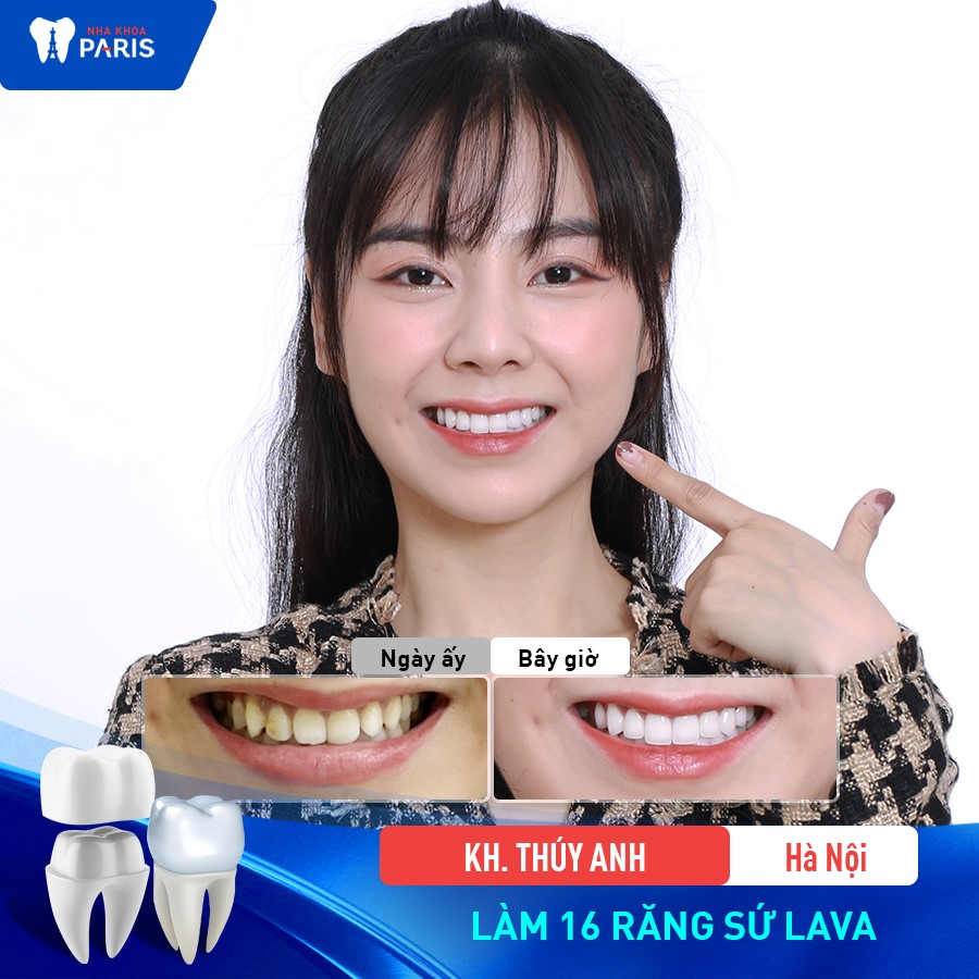 Khách hàng tiến hành bọc răng sứ thẩm mỹ tại nha khoa Paris