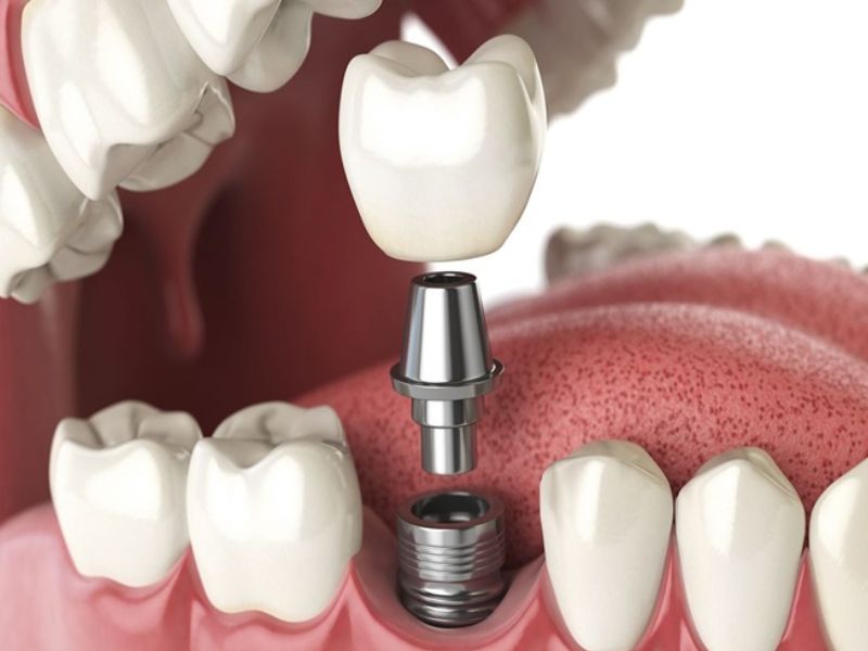 Trồng răng Implant mất khoảng 3 – 6 tháng, tùy vào tình trạng xương hàm, loại trụ và khả năng lành thương
