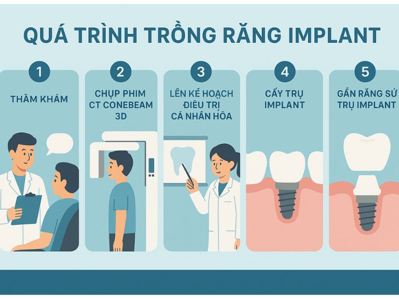 Quá trình trồng răng Implant gồm 5 bước