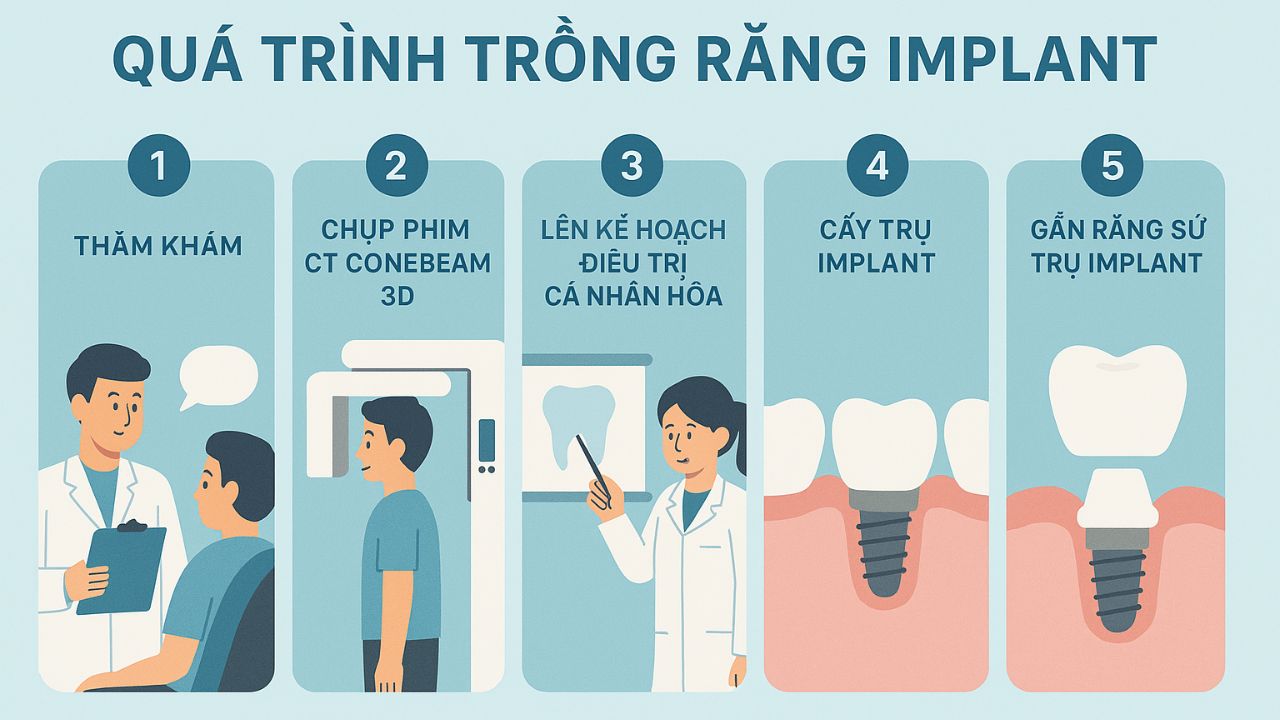 Quá trình trồng răng Implant gồm những bước nào? Chi tiết 5 bước