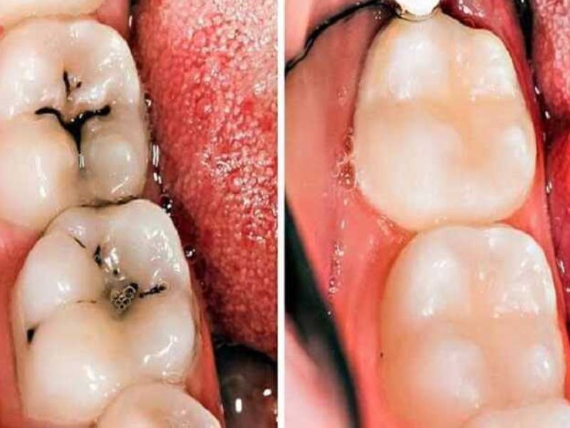 Bọc răng sứ cho răng sâu là bọc một lớp mão sứ lên trên răng đã điều trị sâu để bảo vệ, phục hồi chức năng và cải thiện thẩm mỹ.