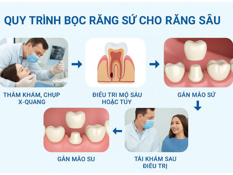Quy trình các bước bọc răng sứ cho răng sâu