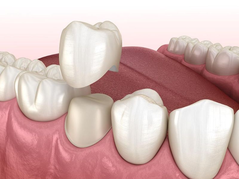 Bọc răng sứ cho răng sâu thường không đau nếu răng chưa tổn thương đến tủy.