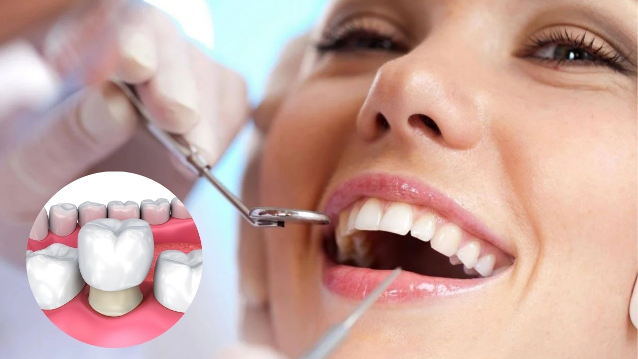 Quy trình bọc răng sứ cho răng sâu chuẩn y khoa 5 bước