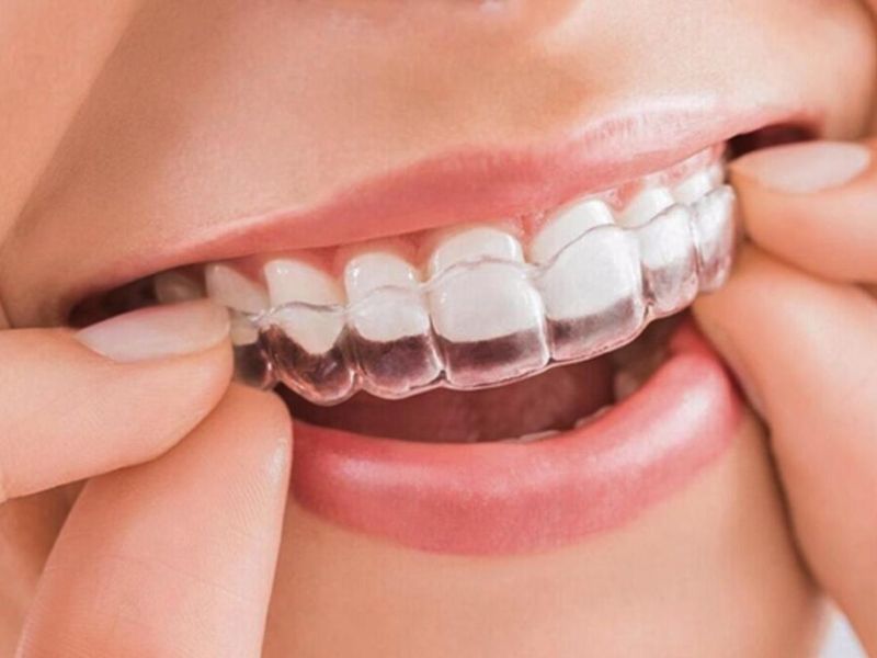 Niềng răng trong suốt Invisalign không gây đau nhức như phương pháp mắc cài kim loại