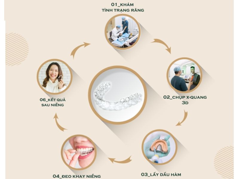 Quy trình niềng răng Invisalign gồm 5 bước