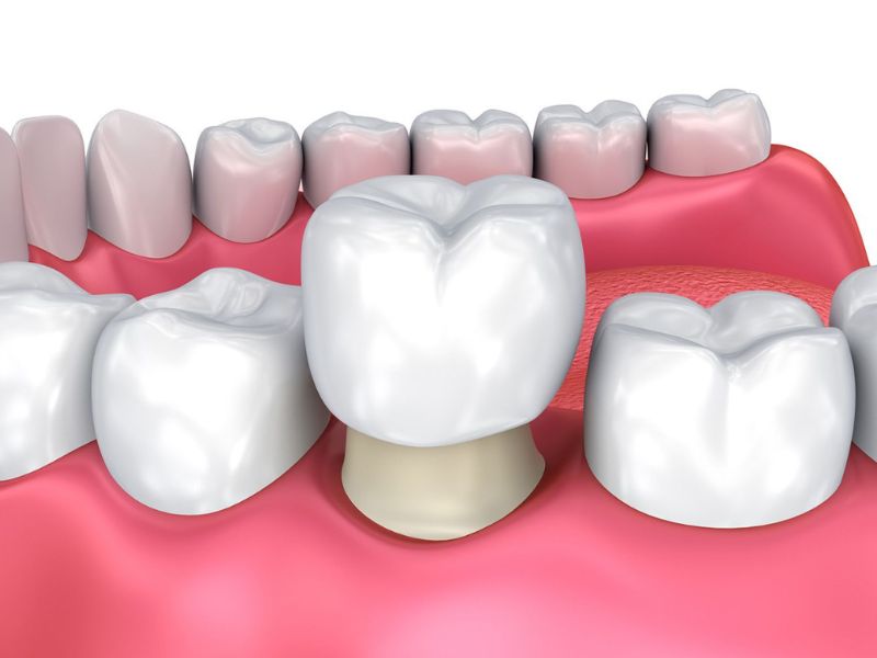 Bọc răng sứ giúp bảo vệ răng thật, ngăn ngừa sâu răng tiến triển, phục hồi chức năng ăn nhai