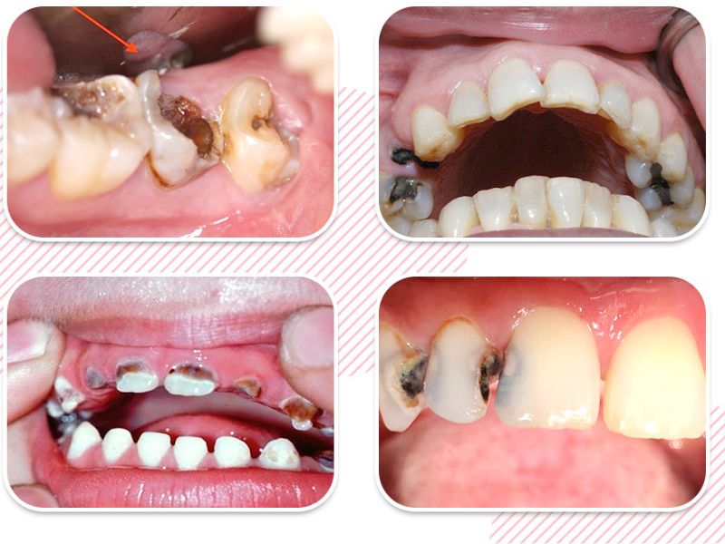 Các trường hợp nên bọc sứ răng sâu