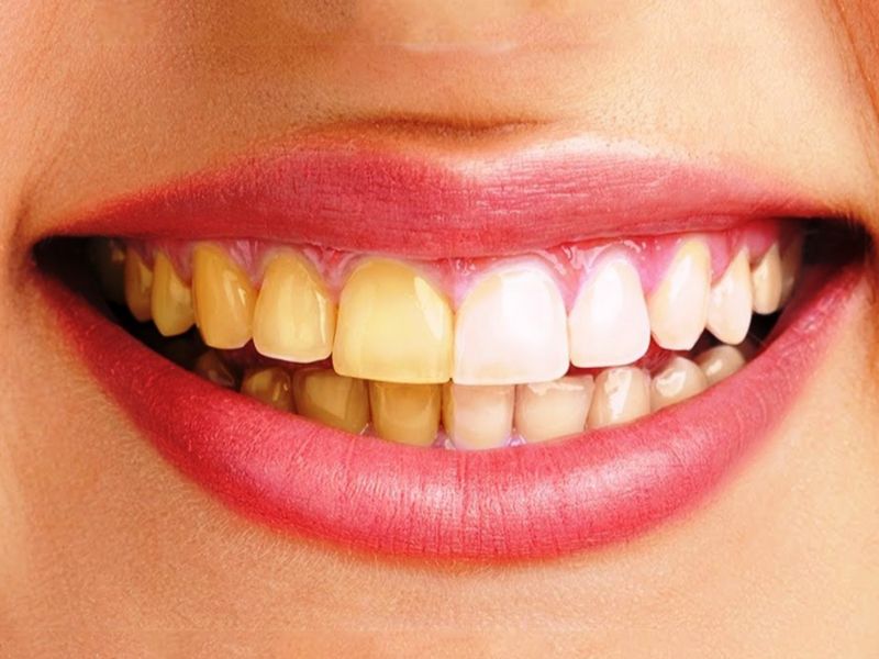 Nguyên nhân răng sứ bị đổi màu
