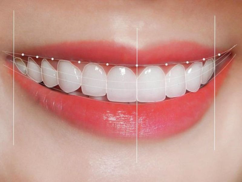 Răng sứ Emax có độ bền cao và khả năng chịu lực tốt lên đến 450 Mpa