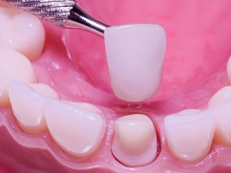 Răng sứ sau khi tháo ra có thể lắp lại trong một số trường hợp nhất định