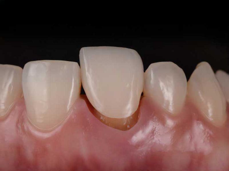 Không nên lắp lại răng sứ cũ nếu mão hoặc răng trụ đã bị tổn hại.
