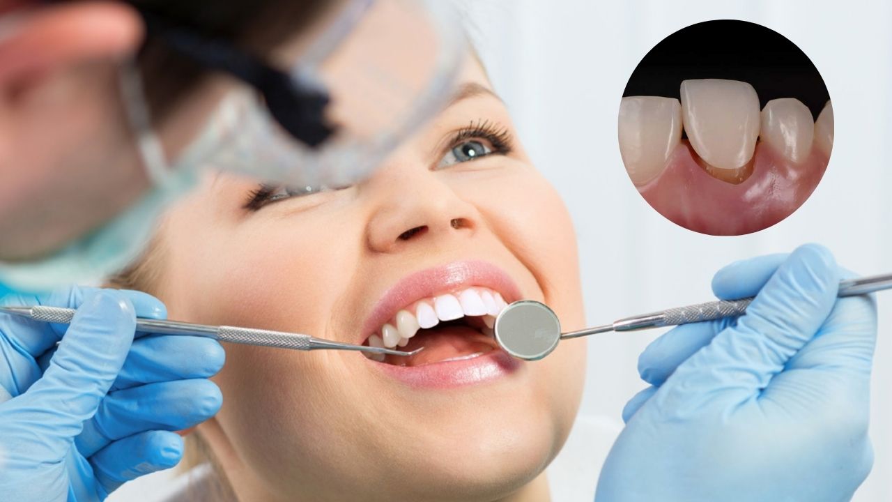 Răng sứ tháo ra có lắp lại được không? cần chú ý điều gì